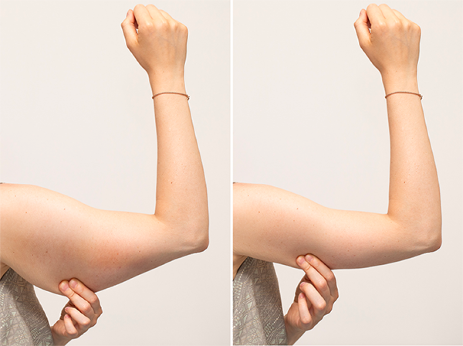 arm-lift