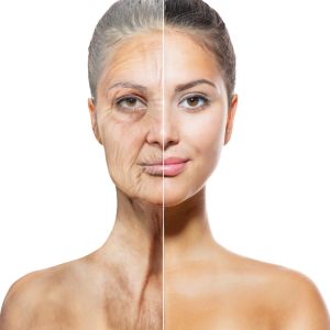 facelift