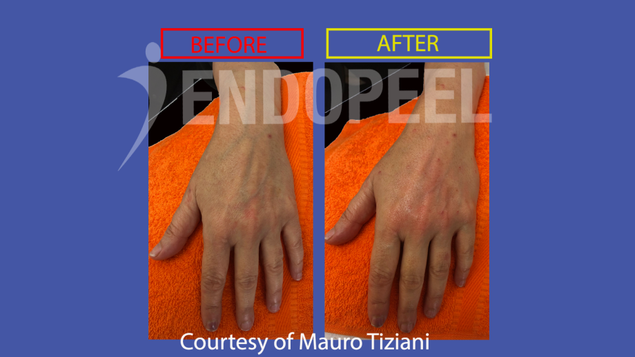 hands lift endopeel tiziani